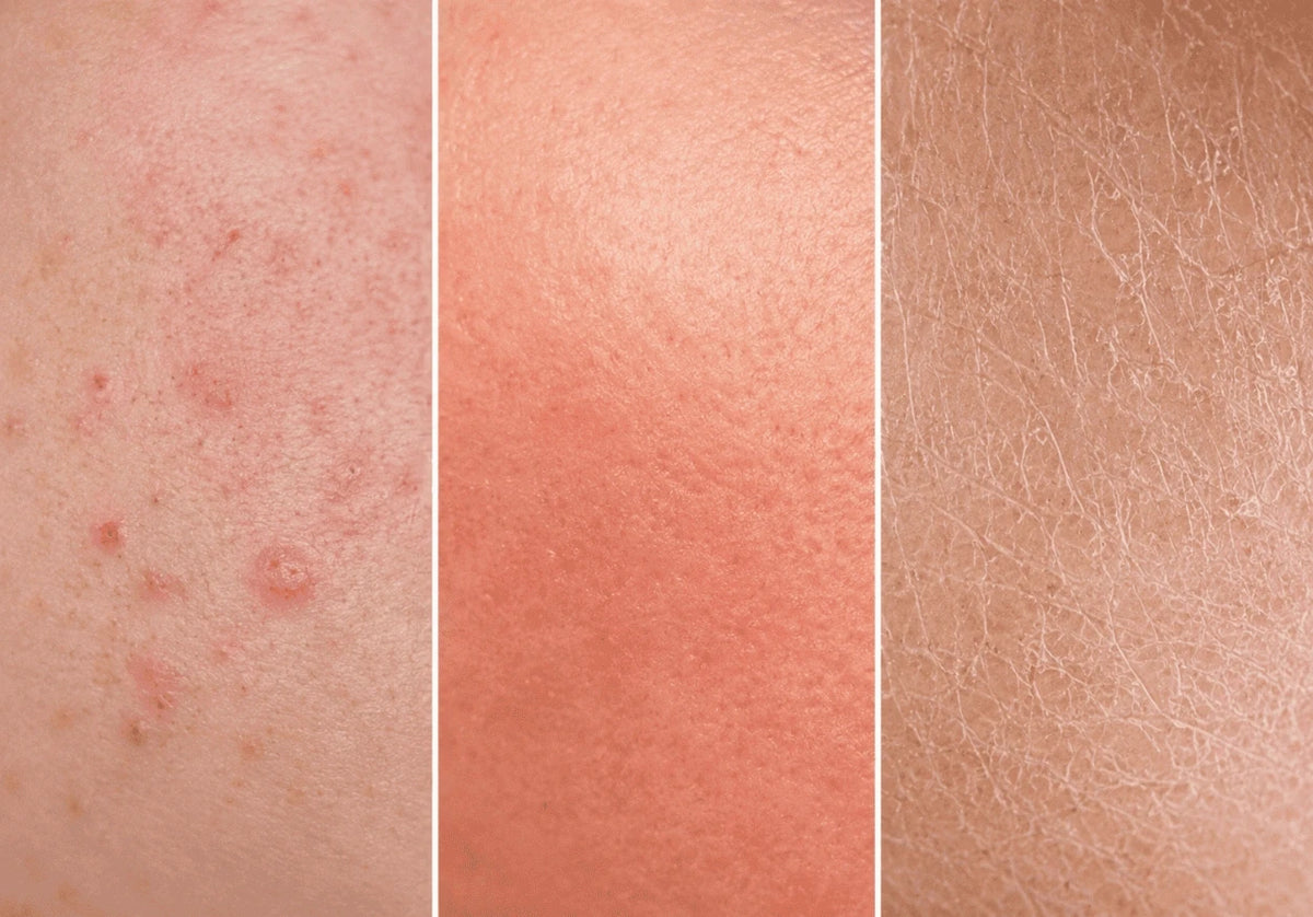 Calm Irritated Skin