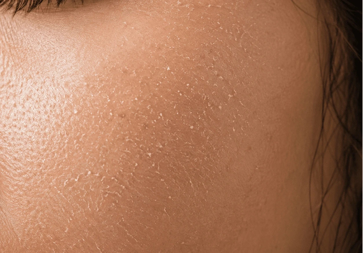 Why Dryness Gets Worse in Winter