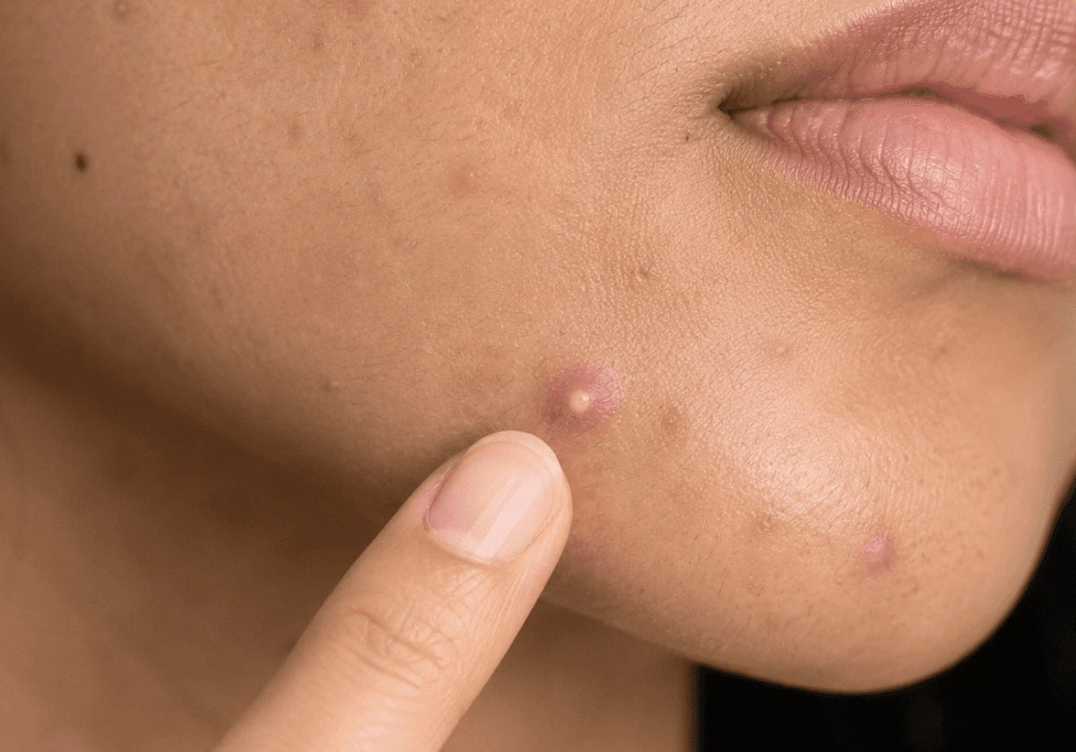 Why Your Skin Breaks Out